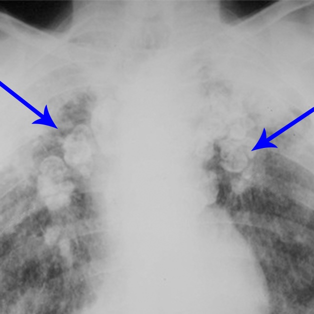 Các loại bệnh về phổi là dấu hiệu nhận biết bệnh